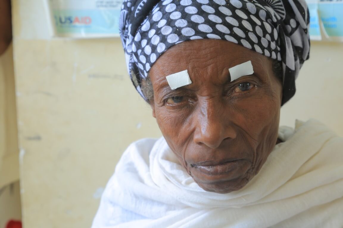Portrait einer Äthiopierin, die an der Augenentzündung Trachom leidet